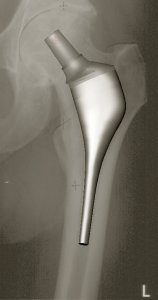 modélisation prothèse hanche sur mesure