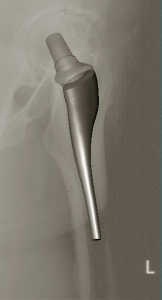 opération hanche, Dr Belot chirurgie orthopédique à rennes