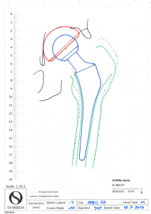 prothèse hanche sur mesure, Dr Belot, chirurgien orthopédiste Rennes