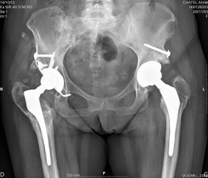 Radiographie J3 de la prothèse hanche à gauche