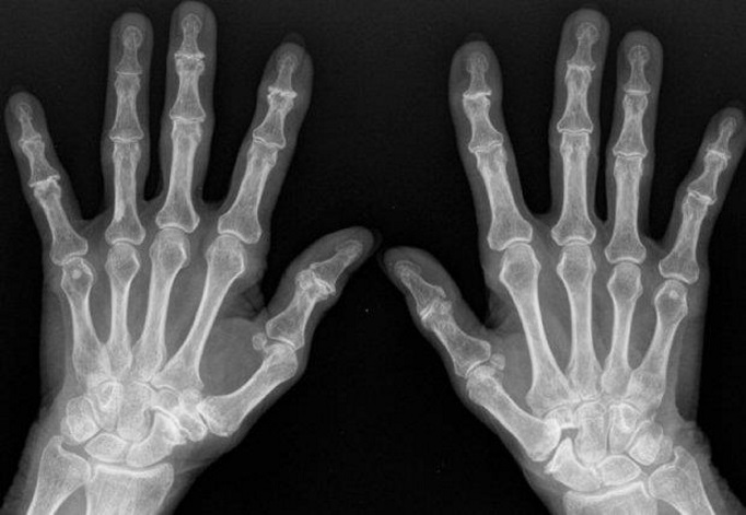 Chirurgie de la main - arthrose digitale à Rennes