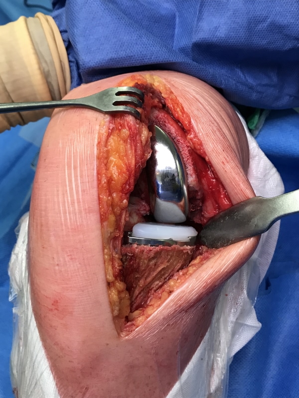 Prothèse UniCompartimentale mise en place remplaçant le cartilage usé.