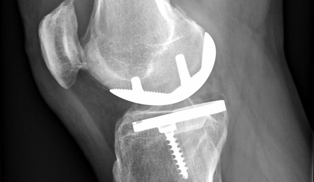 Chirurgie prothèse du genou à Rennes